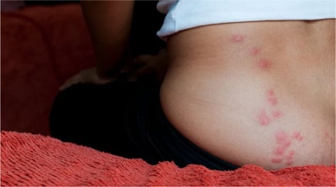 bed bug bite website.jpg