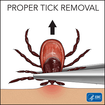 how to remove a tick cdc